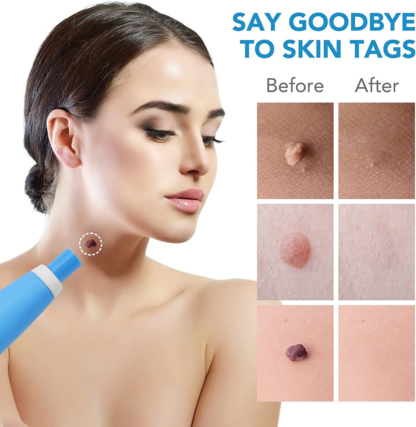 Aliver 2 in 1 Painless Skin Tag Remover Pen