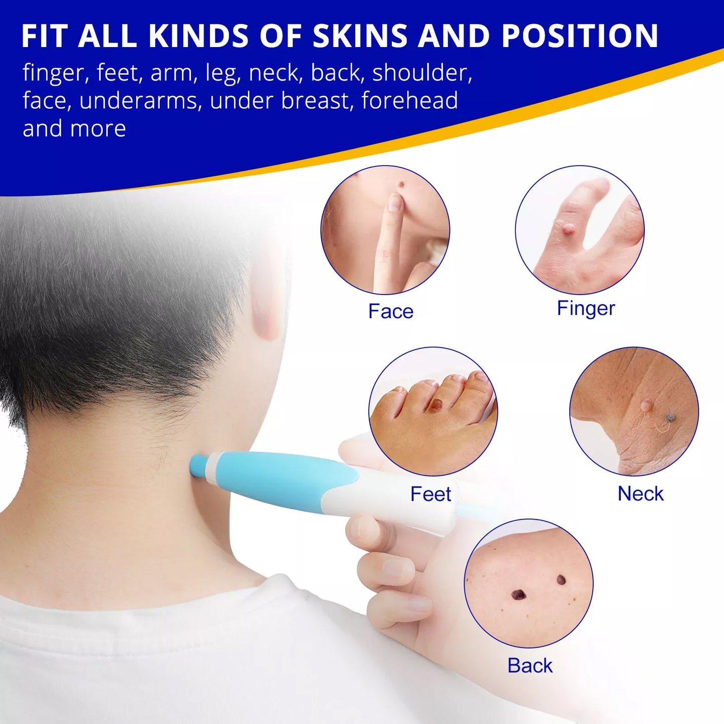 Aliver 2 in 1 Painless Skin Tag Remover Pen