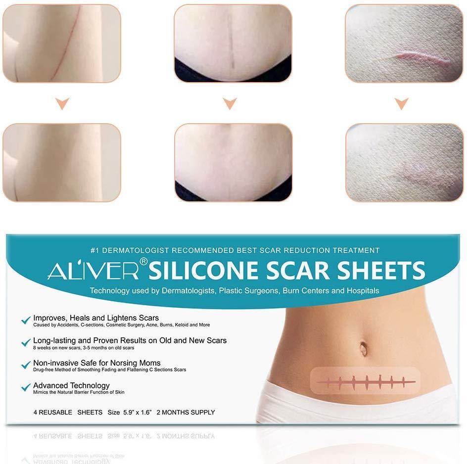 Aliver Silicone Scar Removal Treatment Sheets 4pcs