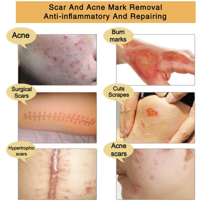 Aliver Acne Treatment & Scar Removal Cream