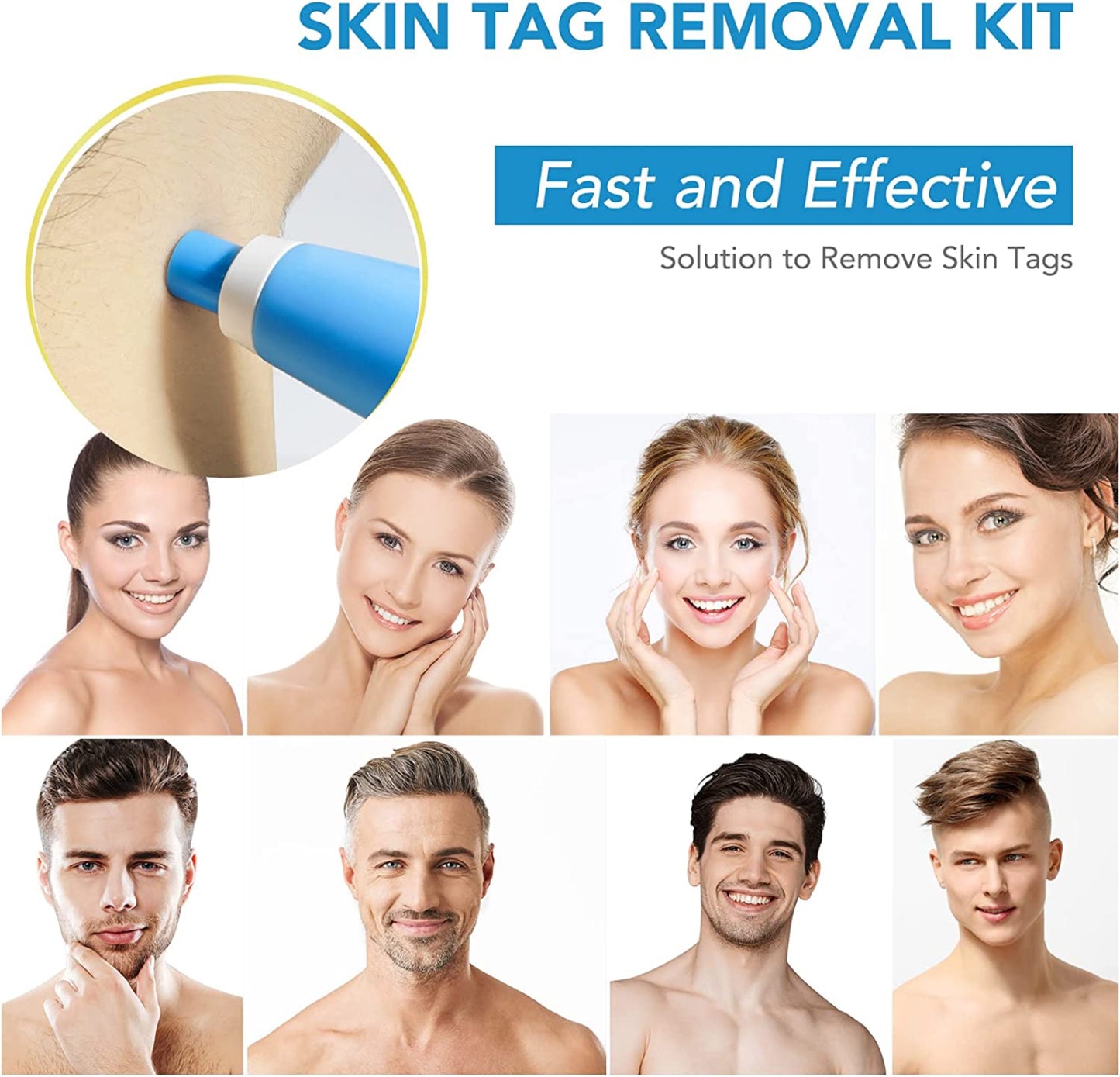 Aliver Skin Tag Remover Kit Painless Mole & Wart Removal Tool