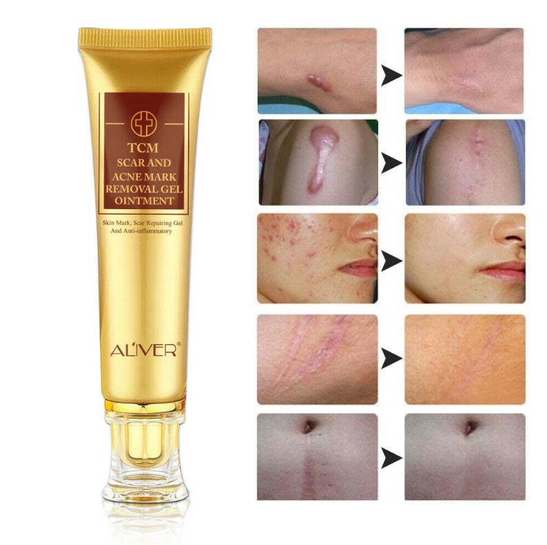 Aliver Acne Treatment & Scar Removal Cream